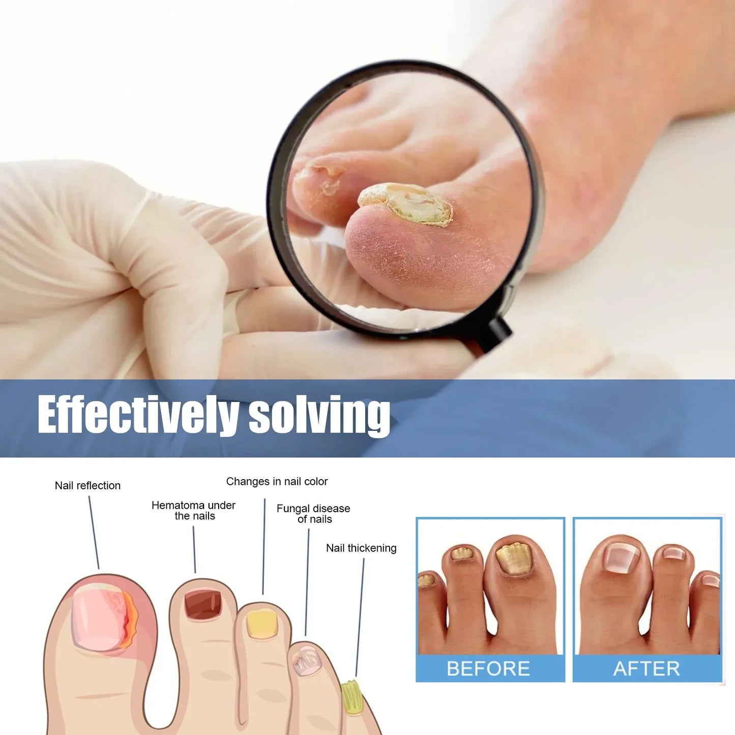 Acezozla® Fungus Nail Repair Patches